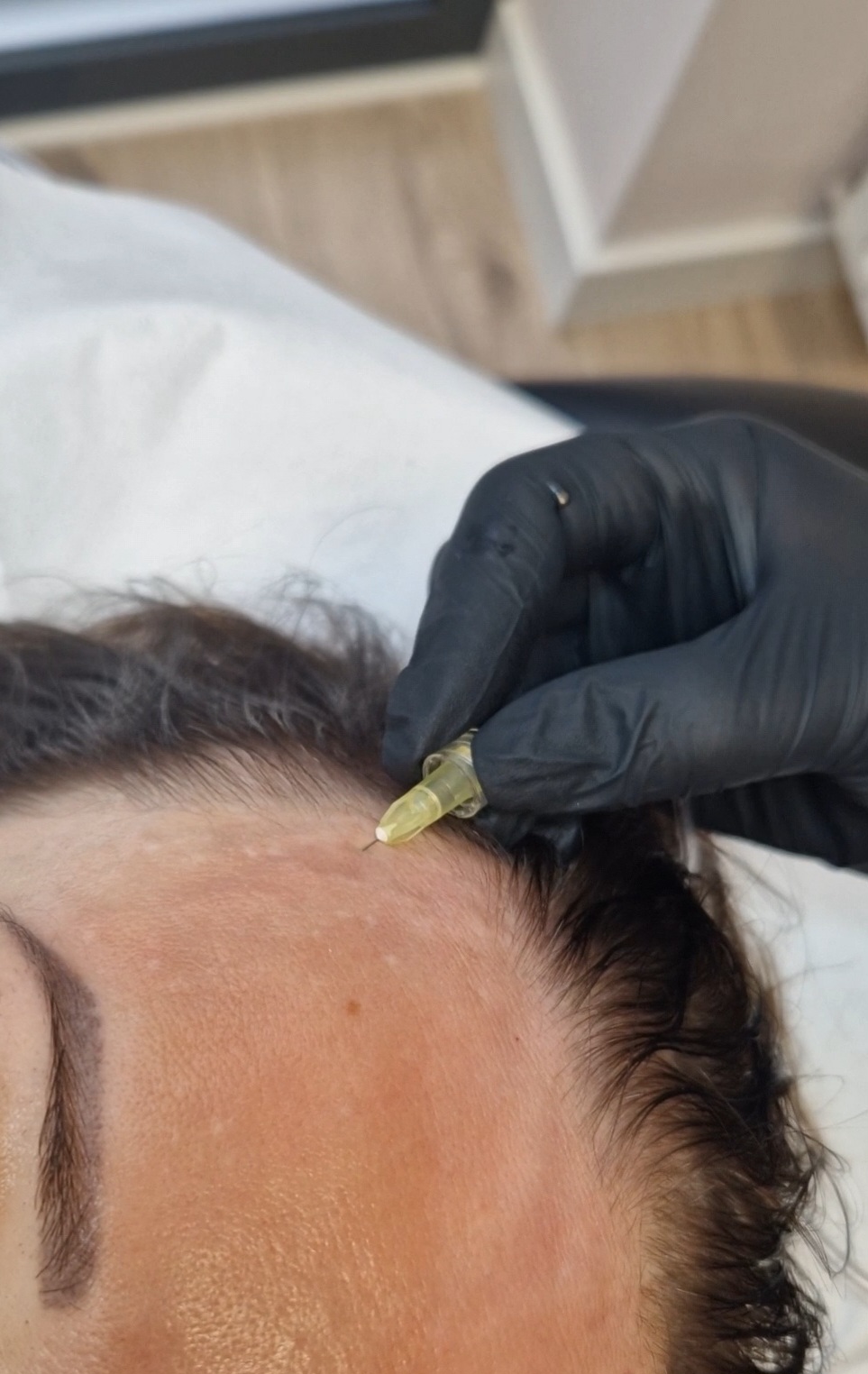 Zdjęcie osoby nakłuwanej podczas zabiegu