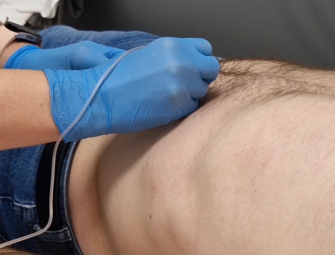 Zdjęcie osoby nakłuwanej podczas zabiegu