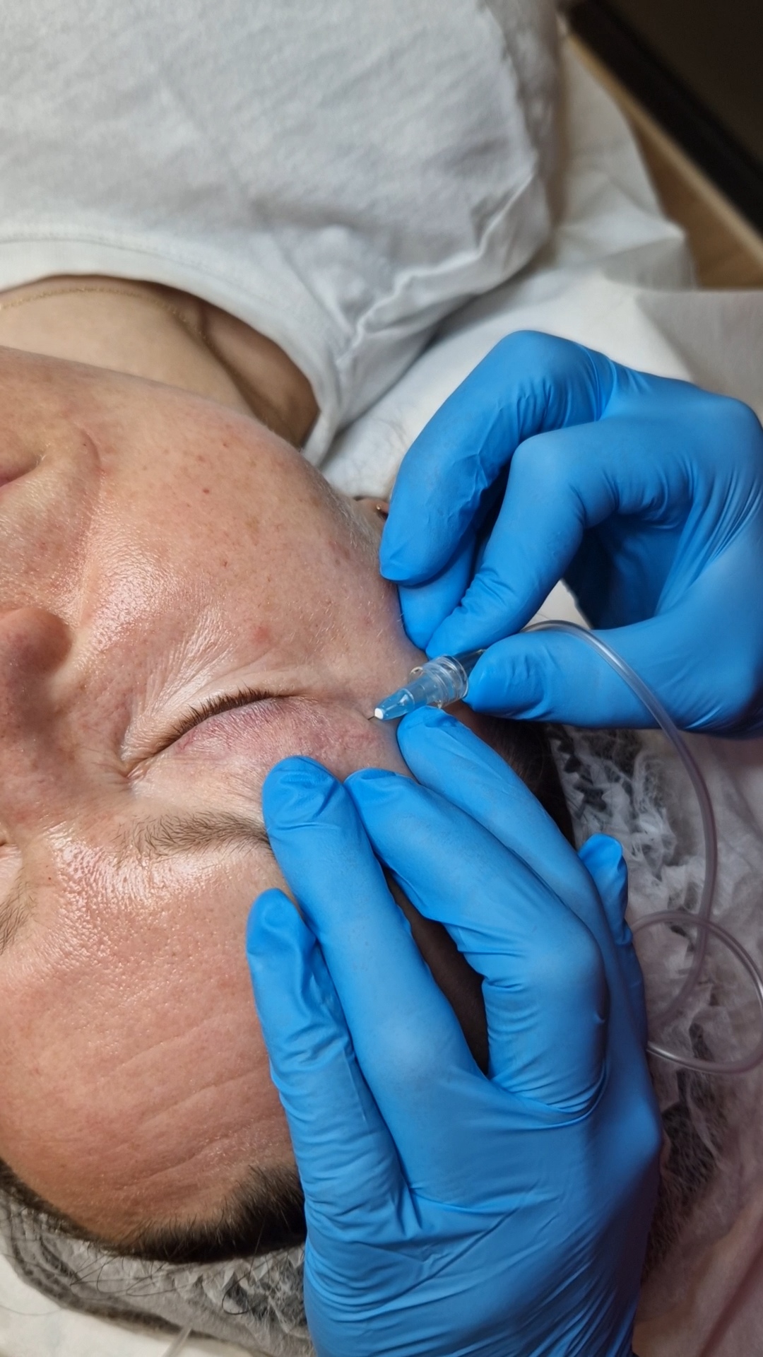 Zdjęcie osoby nakłuwanej podczas zabiegu