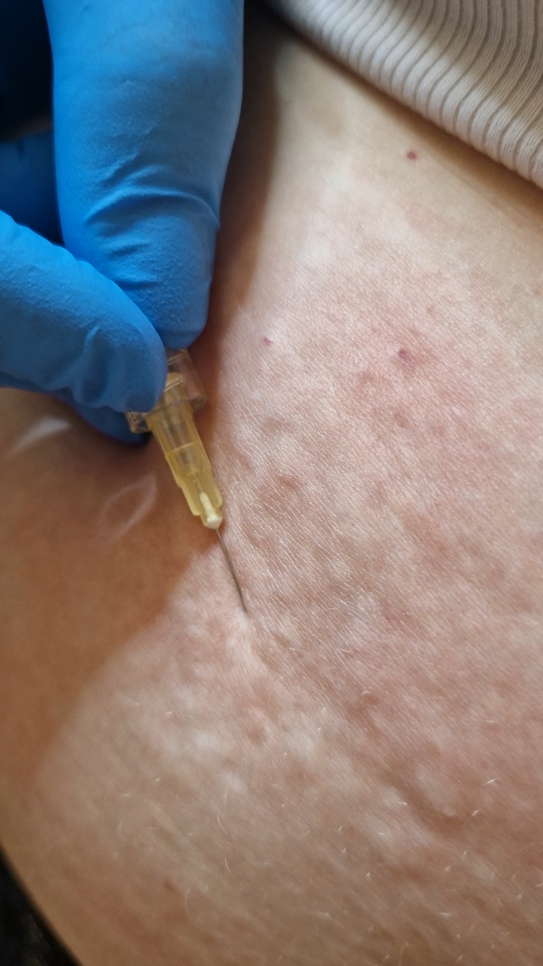 Zdjęcie osoby nakłuwanej podczas zabiegu